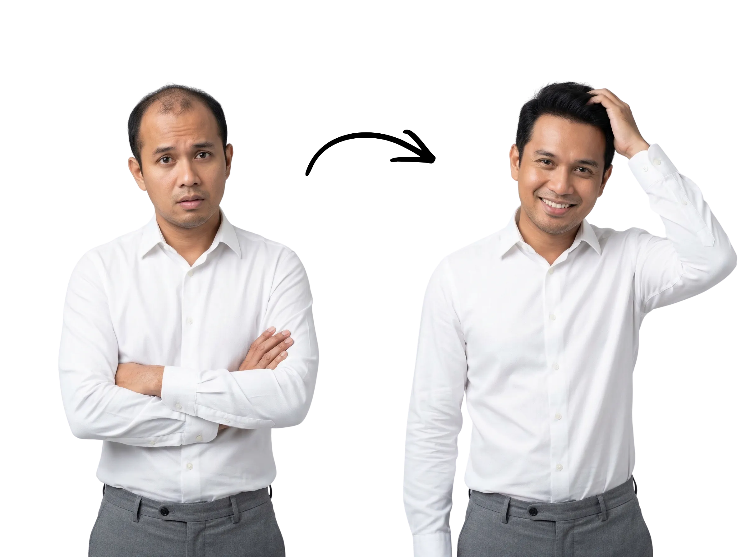 Before and after hair loss treatment — real transformation at MU Scalp Kota Kinabalu